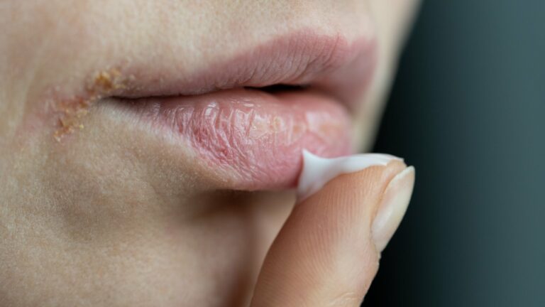 Eine Hand trägt Lippenpflege auf spröde Lippen auf, sichtbar sind trockene Hautstellen.